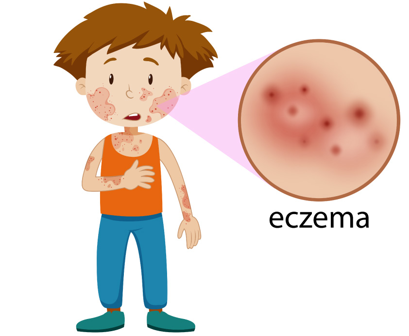 6 Things You Should Know About Eczema Atopic Dermatitis Causes